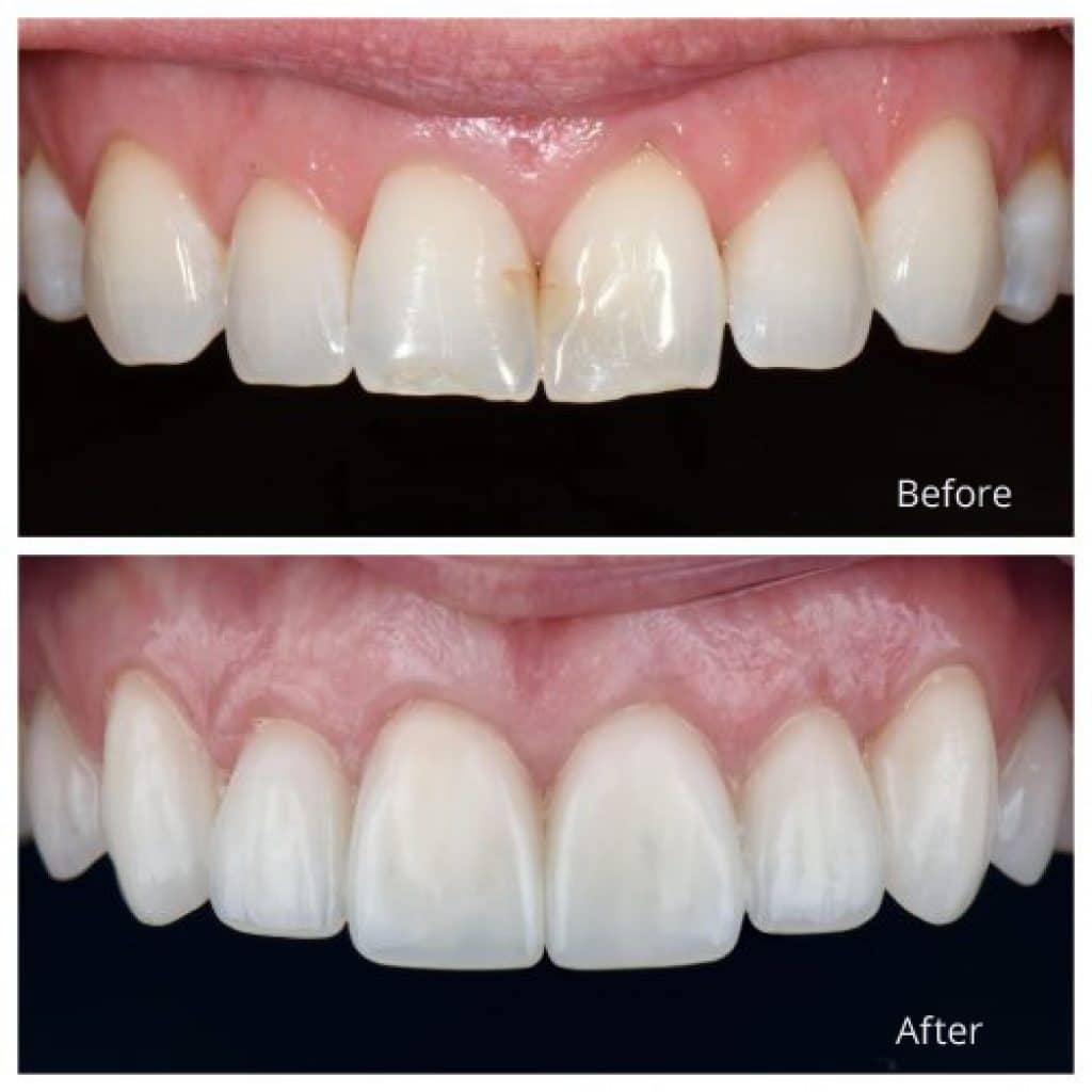 porcelain veneers