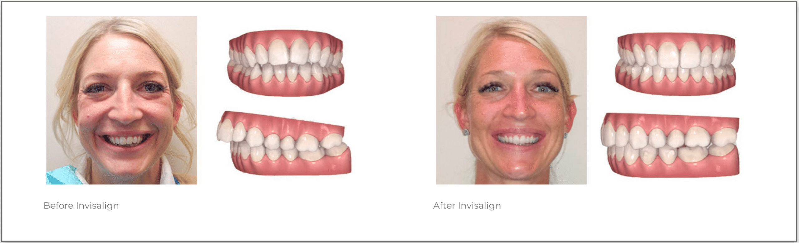 Invisalign or braces: Which should you choose?